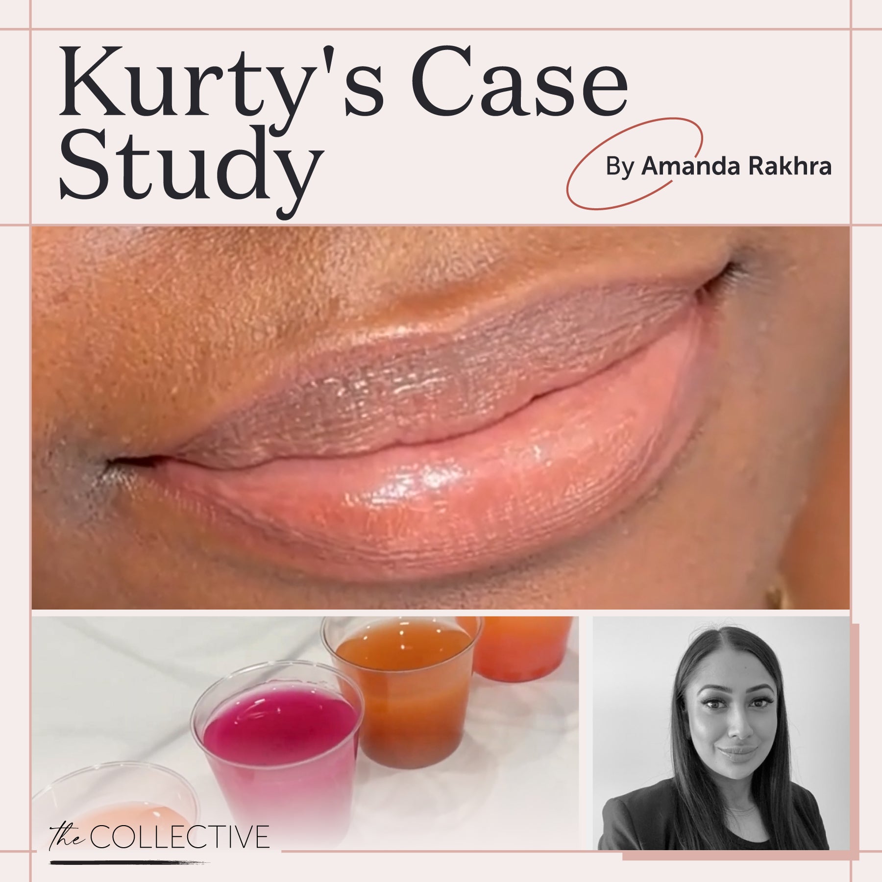 Fitz 6 Dark Lip Neutralization: Kurty’s Case Study by Amanda Rakhra