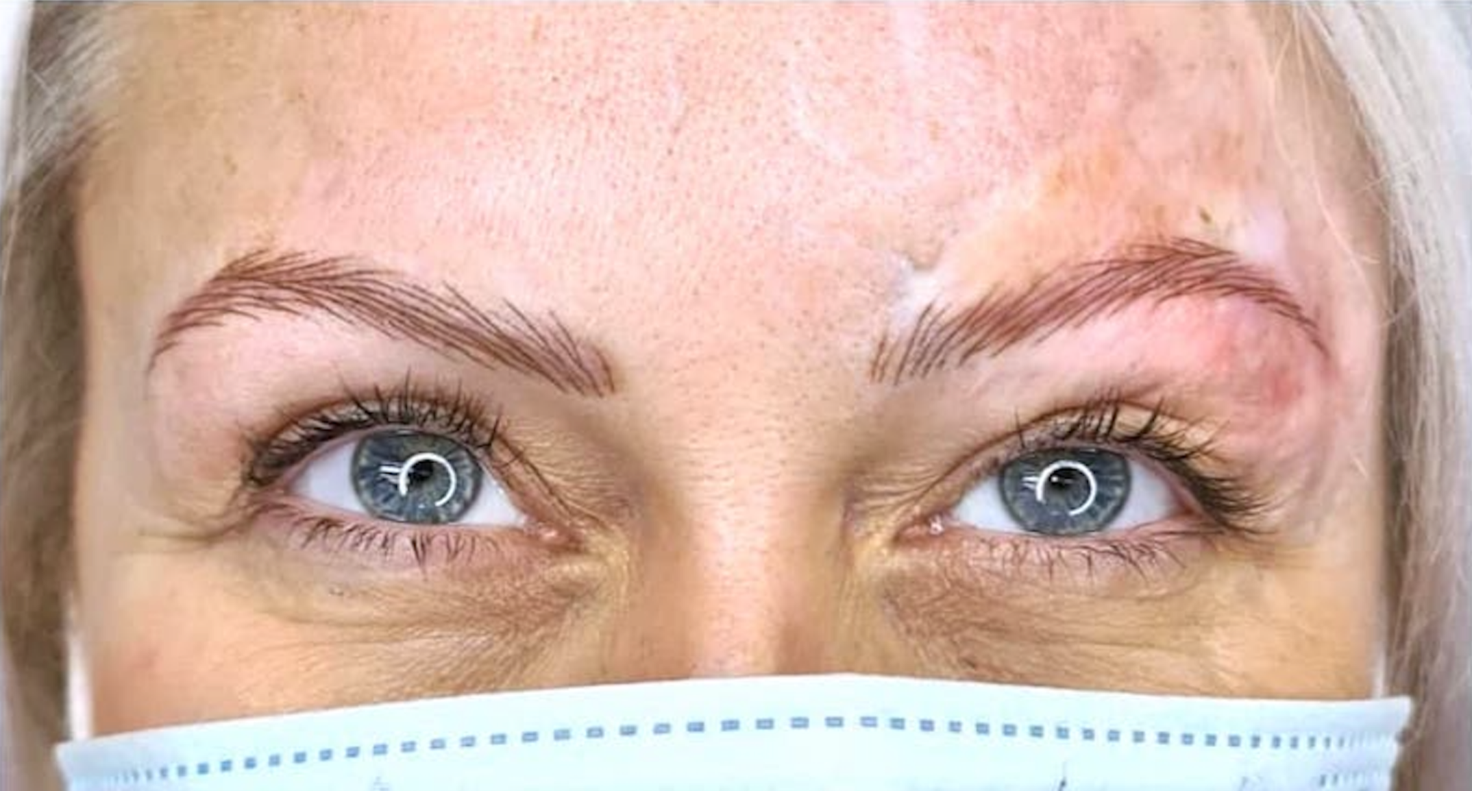 Case Study Nanobrows and Tattooing with Scarring on Tina Davies Professional