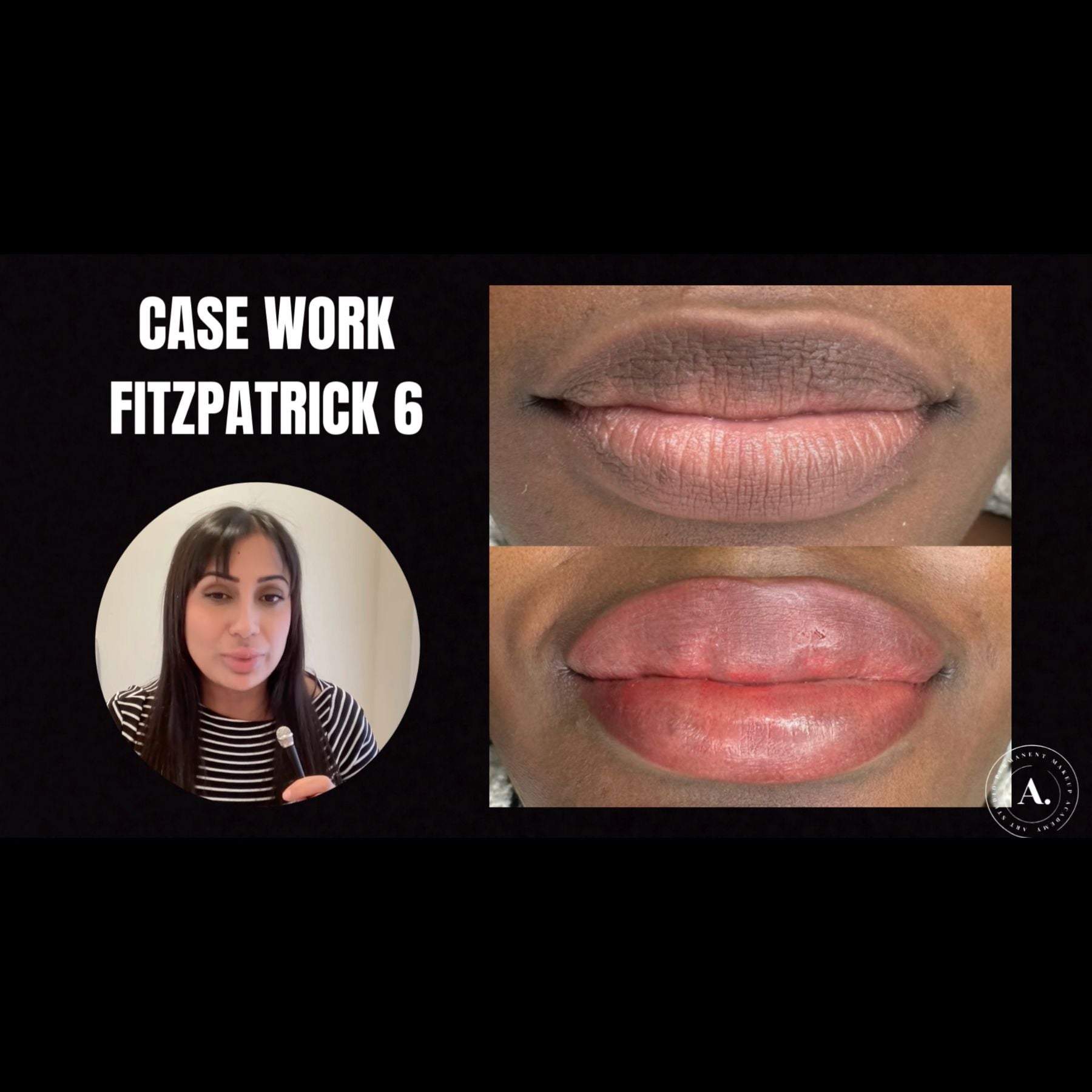 Fitz 6 Dark Lip Neutralization: Kurty’s Case Study by Amanda Rakhra
