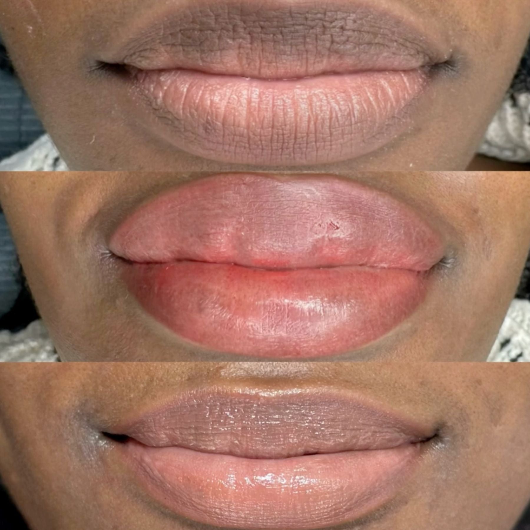 Fitz 6 Dark Lip Neutralization: Kurty’s Case Study by Amanda Rakhra
